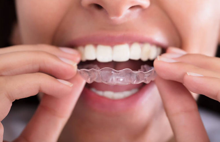 Mouthpieces