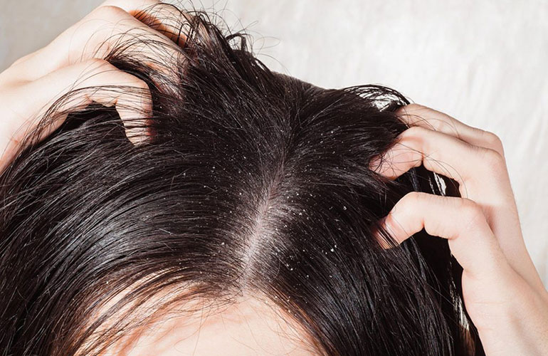 How often should you wash with a scalp disorder?