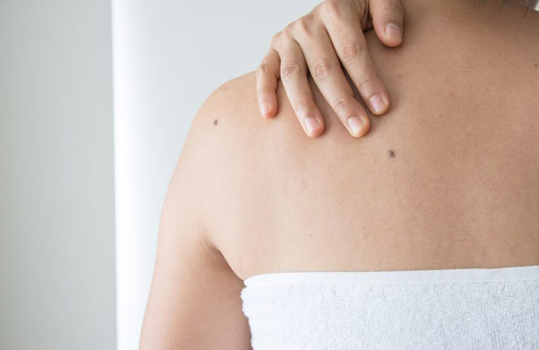 One of your moles is not like the others