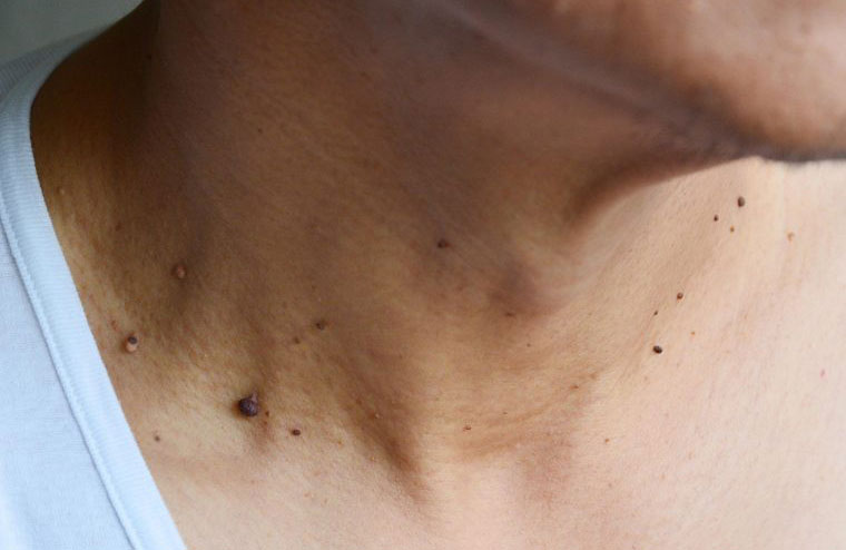 Skin growths or moles that aren’t brown or black