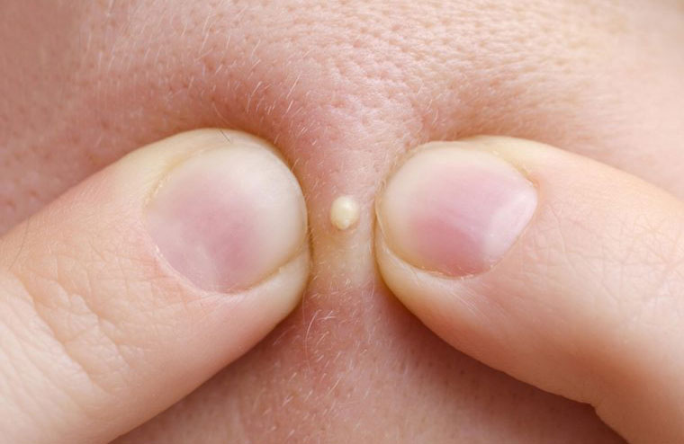 A pimple that doesn’t go away