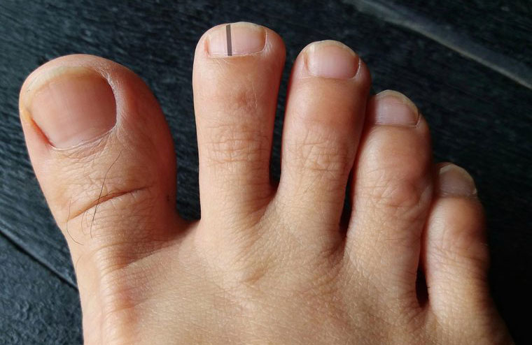 A dark band on your nail