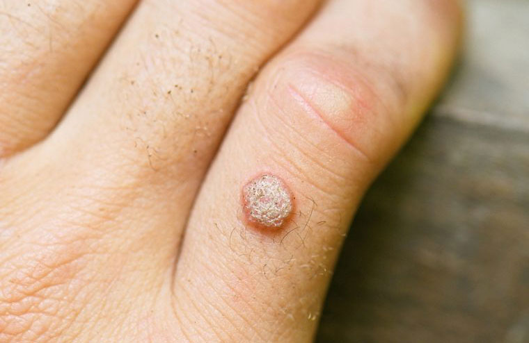 You’ve had an HPV infection