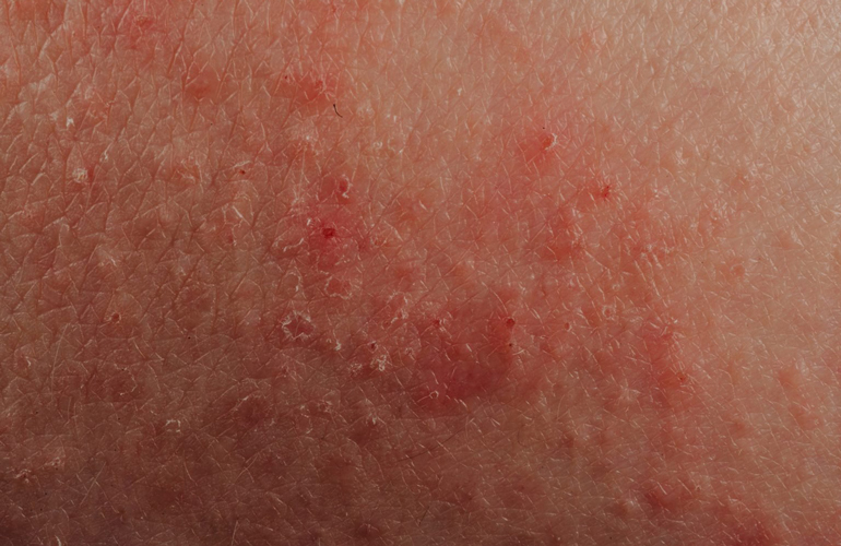 Allergies