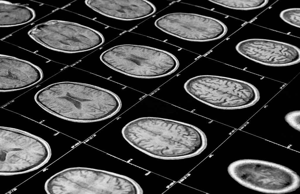 Myth: Autism only affects the brain