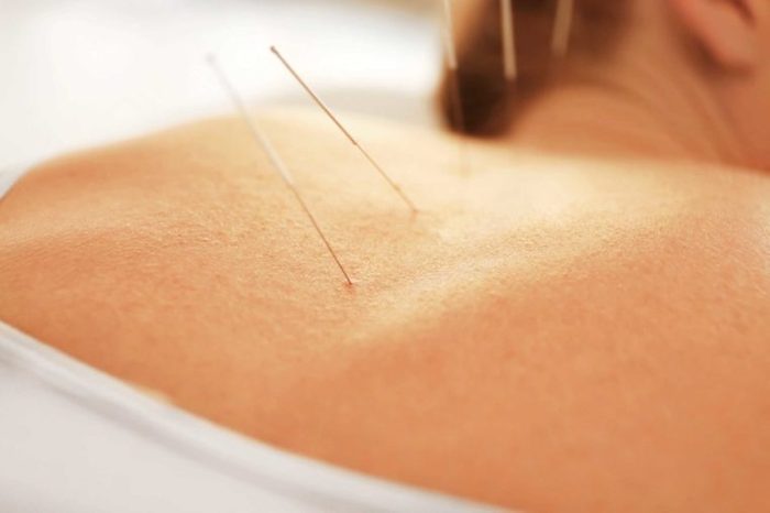 Book an acupuncture session
