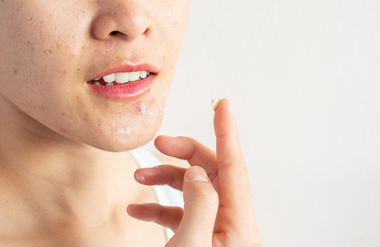 Zap those zits for six months at a time