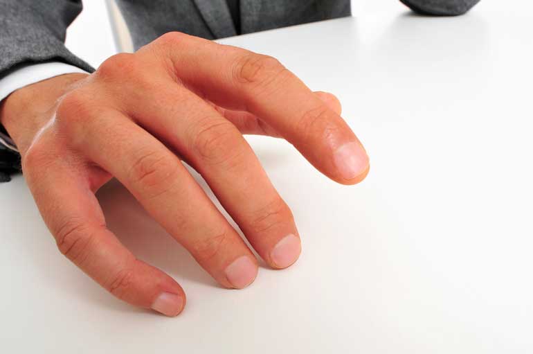 Some people are born without fingerprints