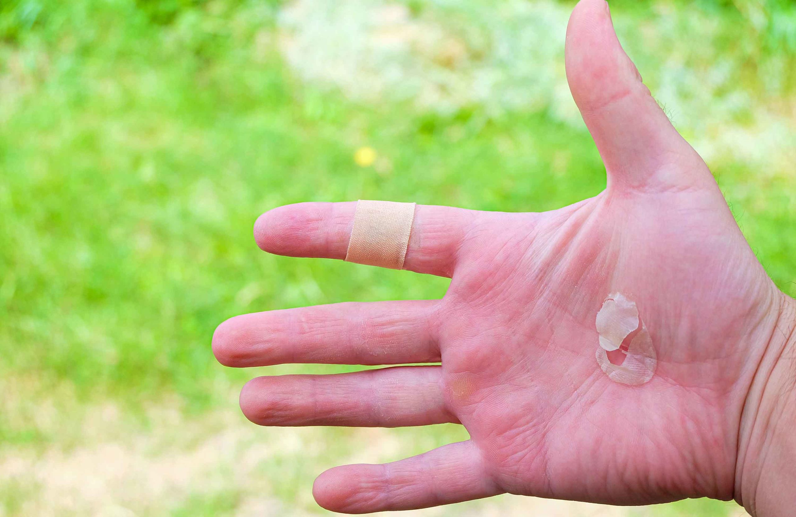 Fingerprints may help prevent blisters